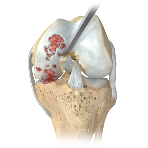 Arthose unicompartimentale du genou