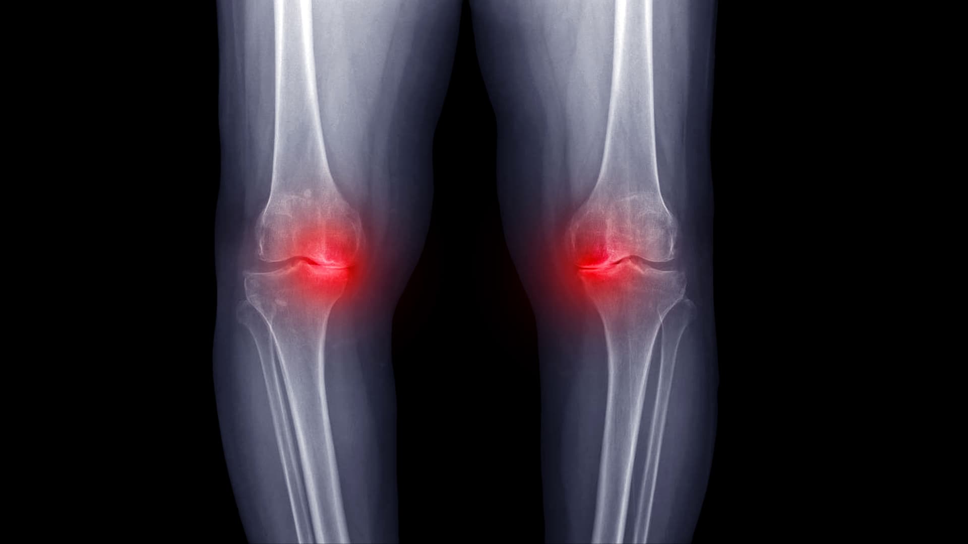 Zones de douleur de l'arthrose du genou