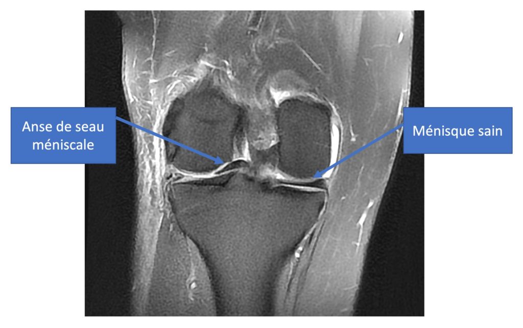 Suture méniscale Réparation d