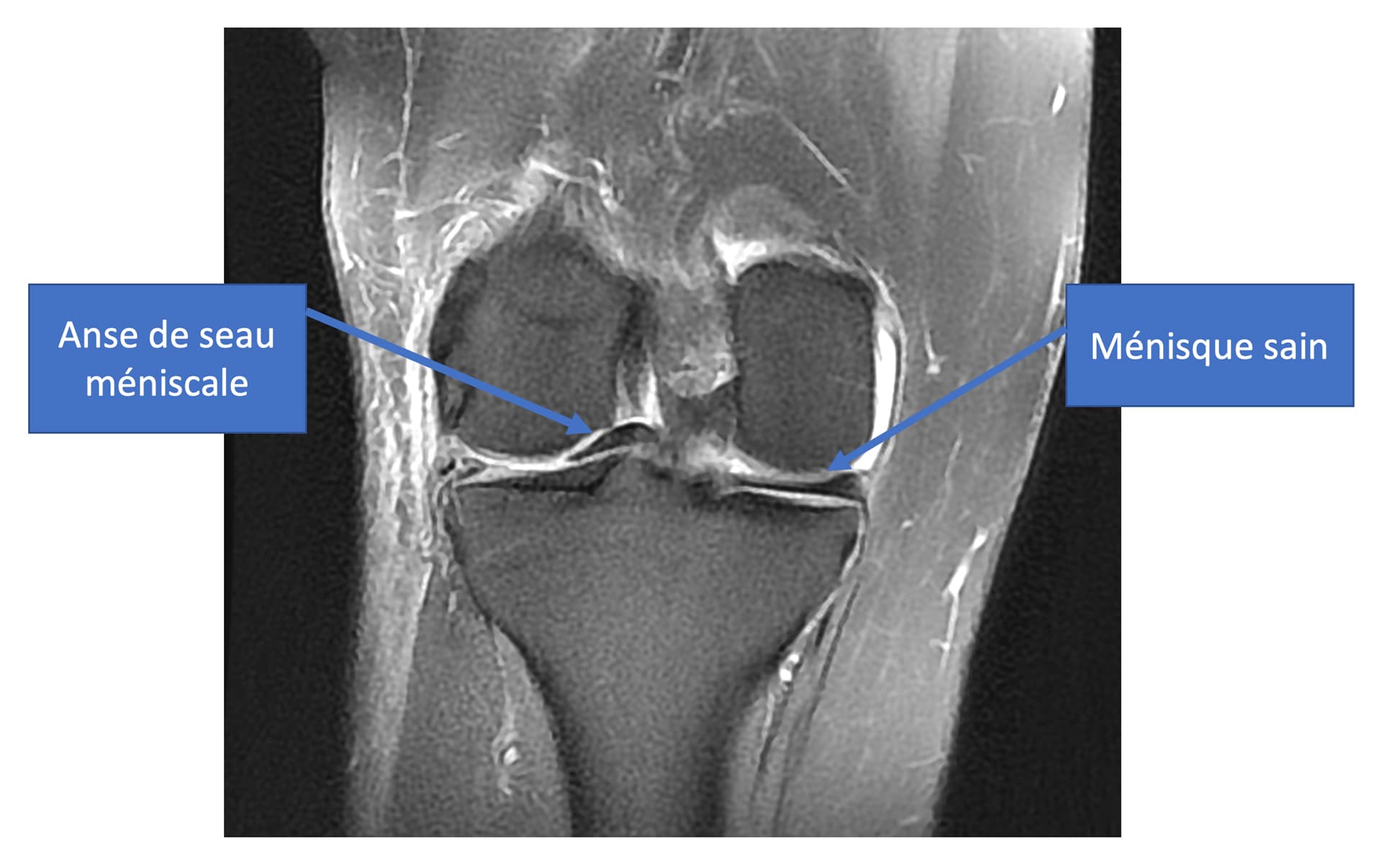 Lésion méniscale : Anse de seau