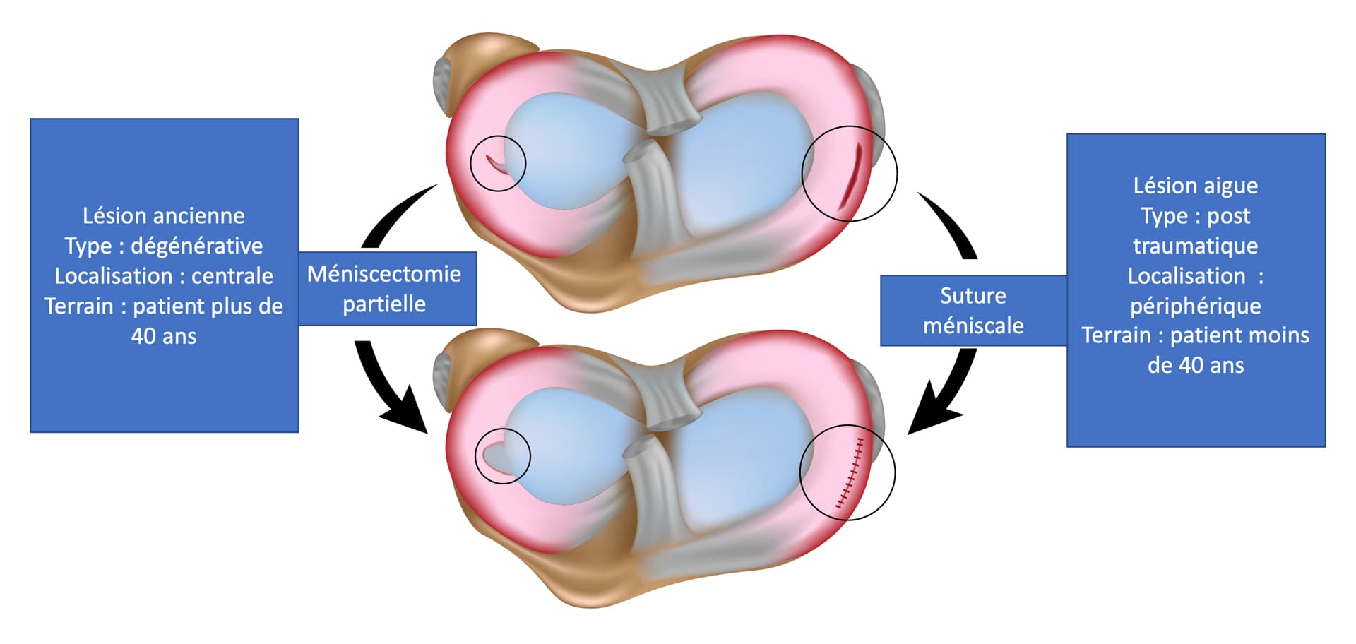 Schema expliquant les lésions méniscales suturables et non suturables