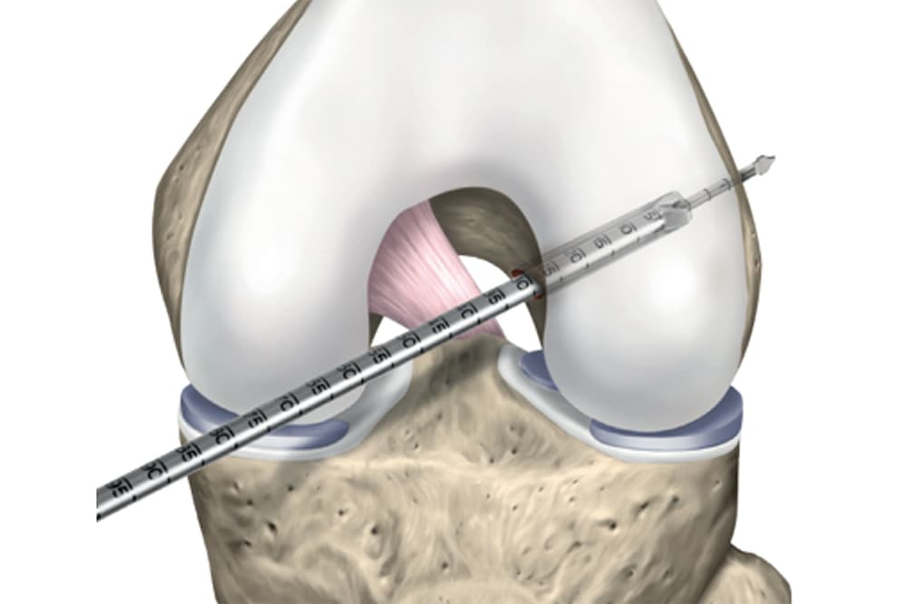 Opération ligament croisé antérieur | Ligamentoplastie genou ...