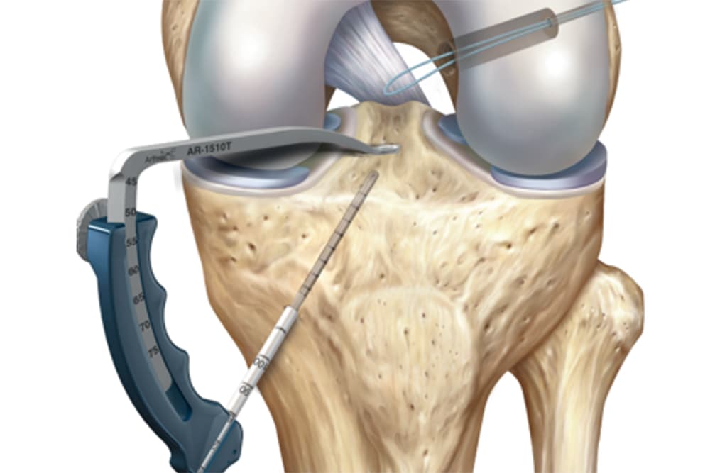 Méchage du tunnel tibial