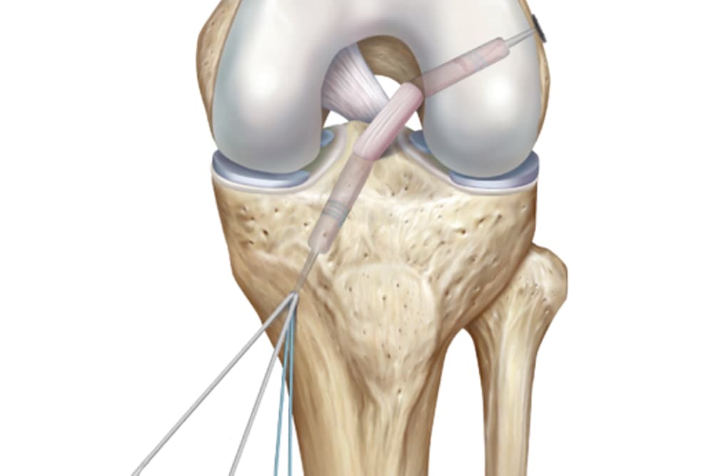 Mise en tension du nouveau ligament croisé