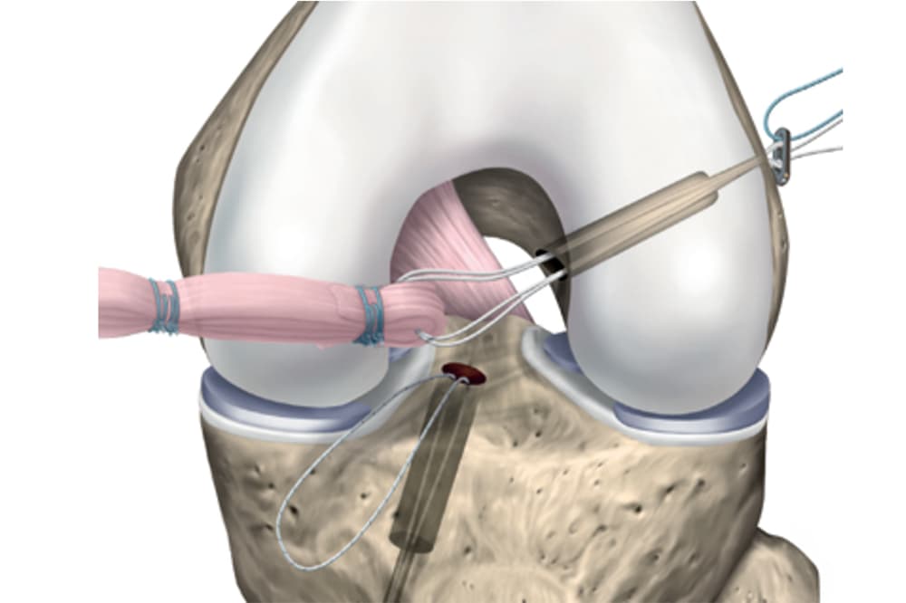 Opération ligament croisé antérieur | Ligamentoplastie genou ...