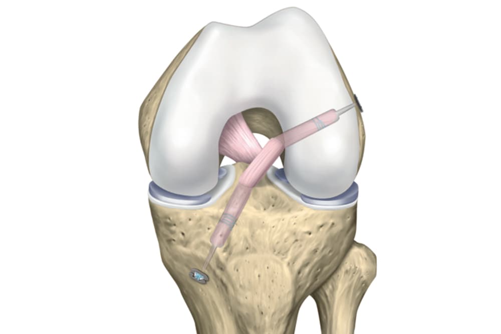 Opération ligament croisé antérieur | Ligamentoplastie genou ...