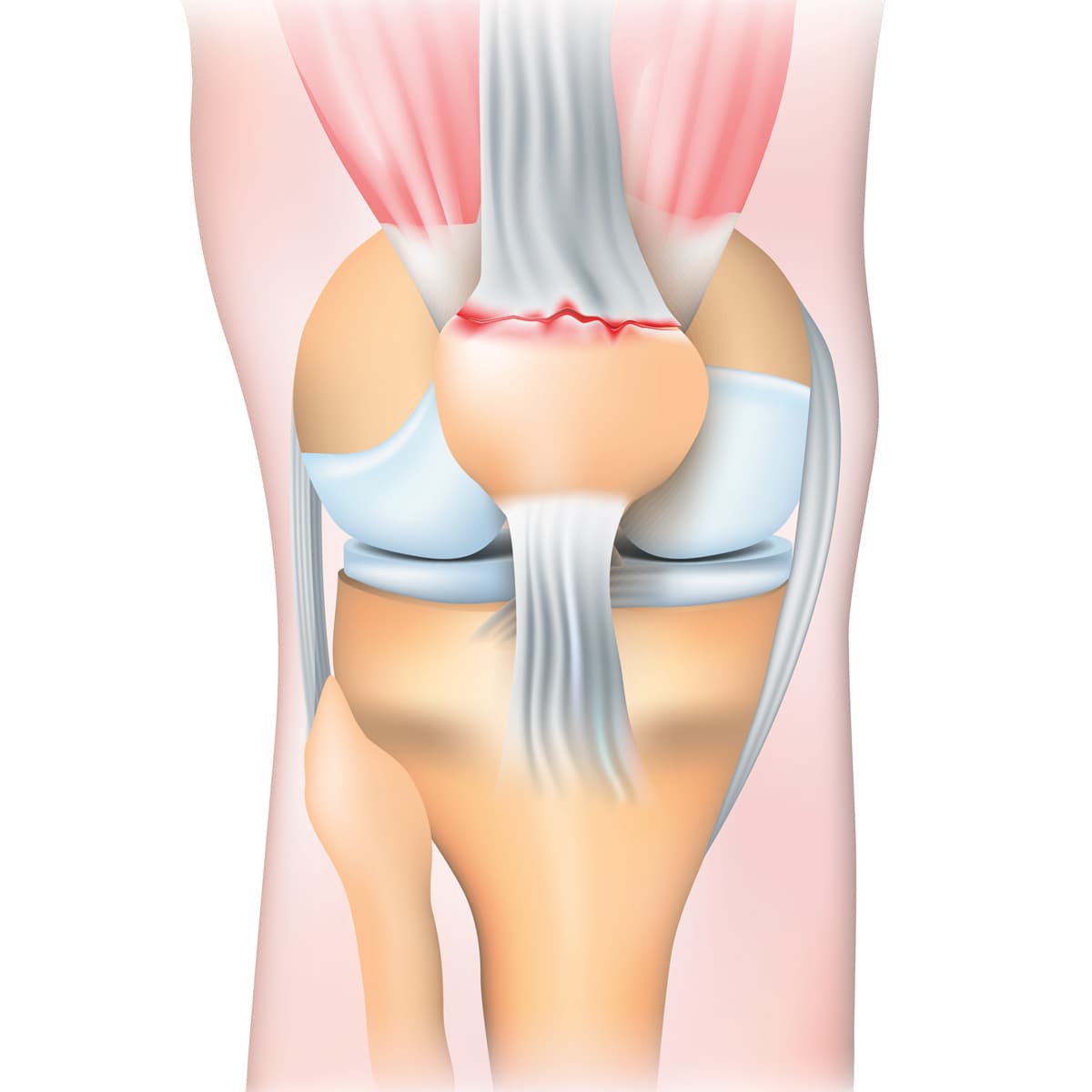 Schema illustrant la rupture du tendon quadriceps