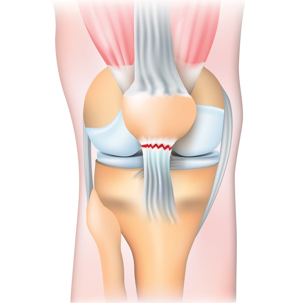 Schema illustrant la rupture du tendon rotulien