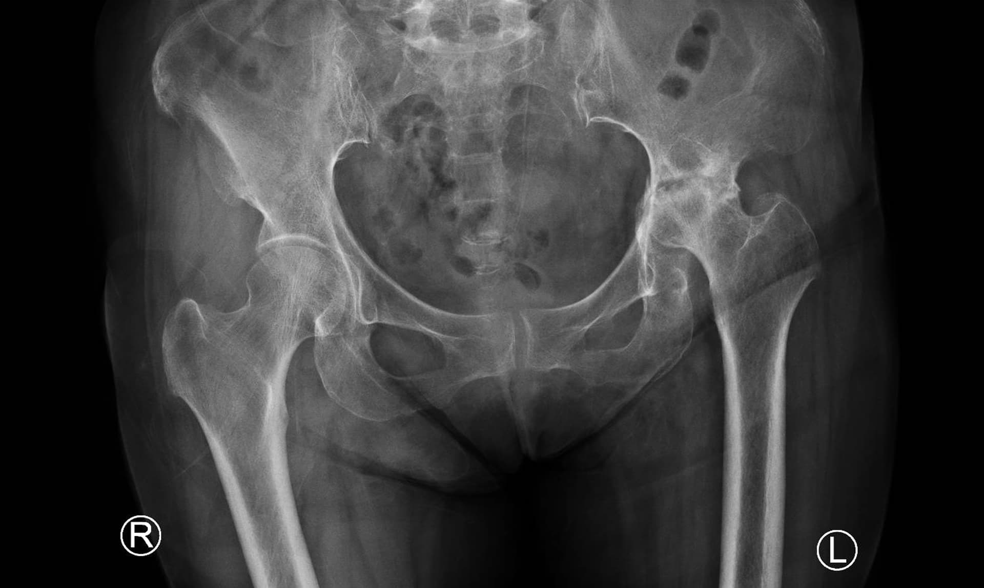 ostéonécrose de la hanche au stade arthrosique