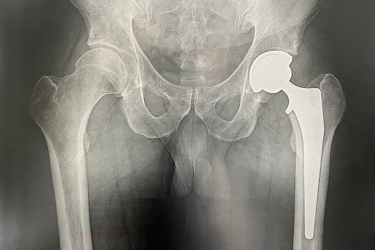 Prothèse totale de hanche