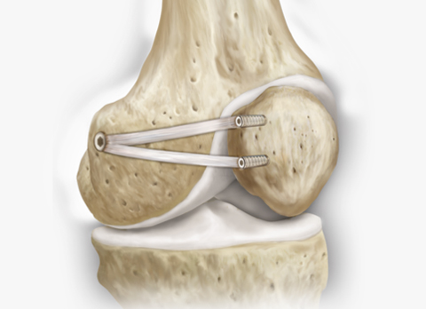 Reconstruction MPFL