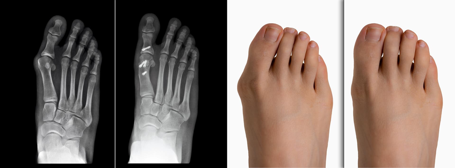 Resultats avant après de traitement de l'hallux valgus