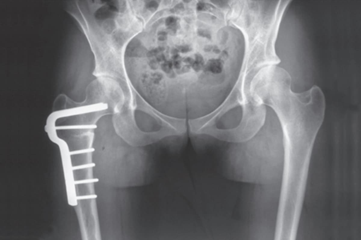 Traitement conservateur d'une ostéonécrose de hanche
