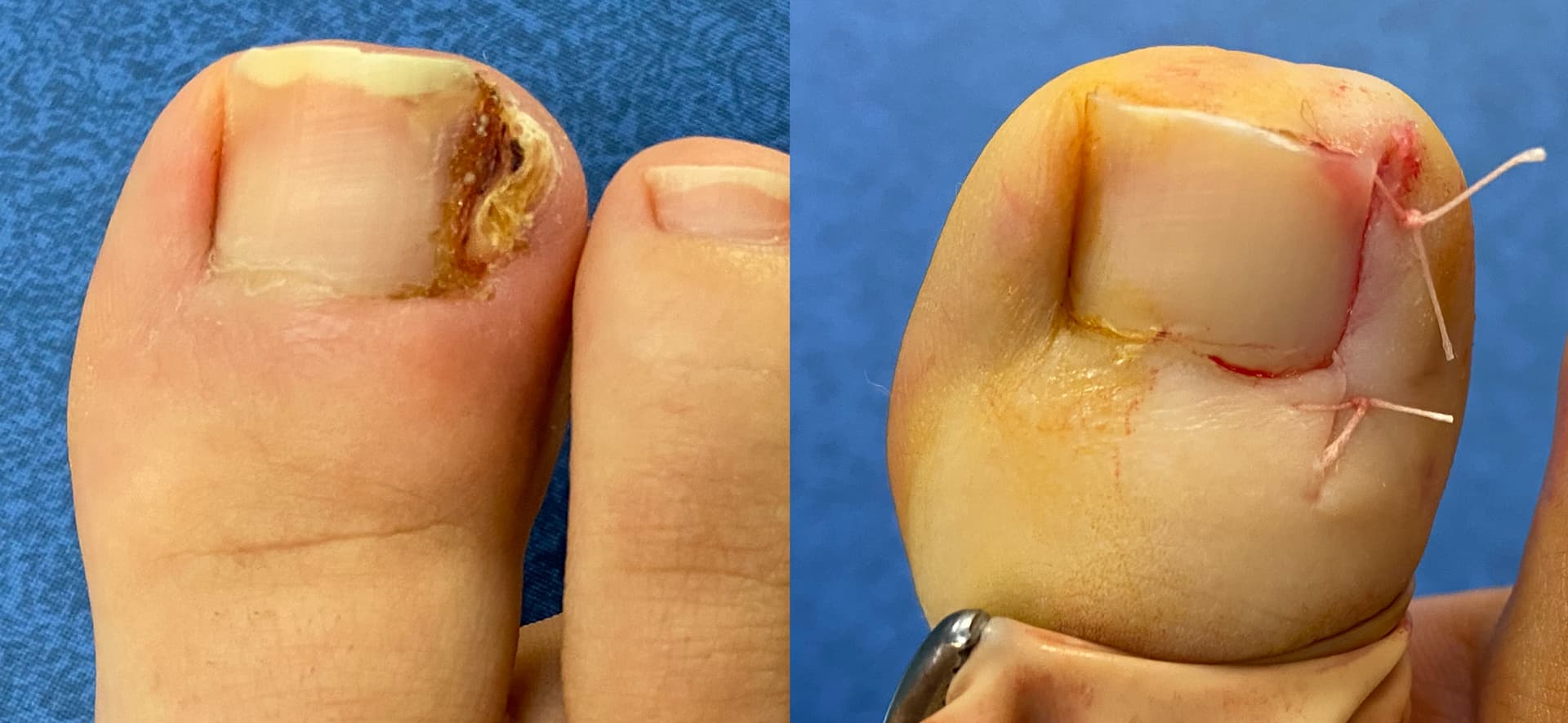 Résultat d'une chirurgie de l'ongle incarné