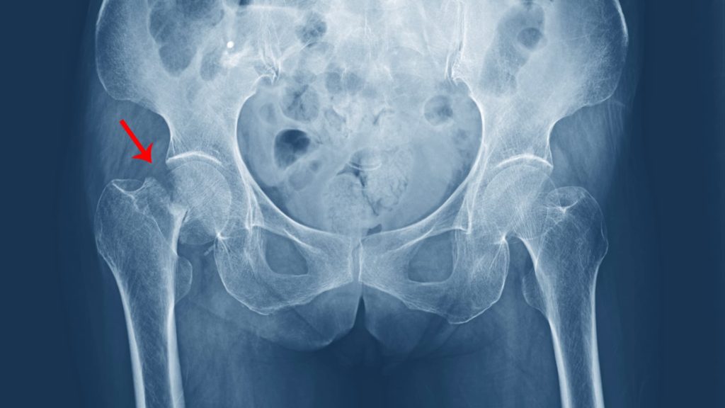 Fracture de hanche Types de fractures et traitements CPHG Paris