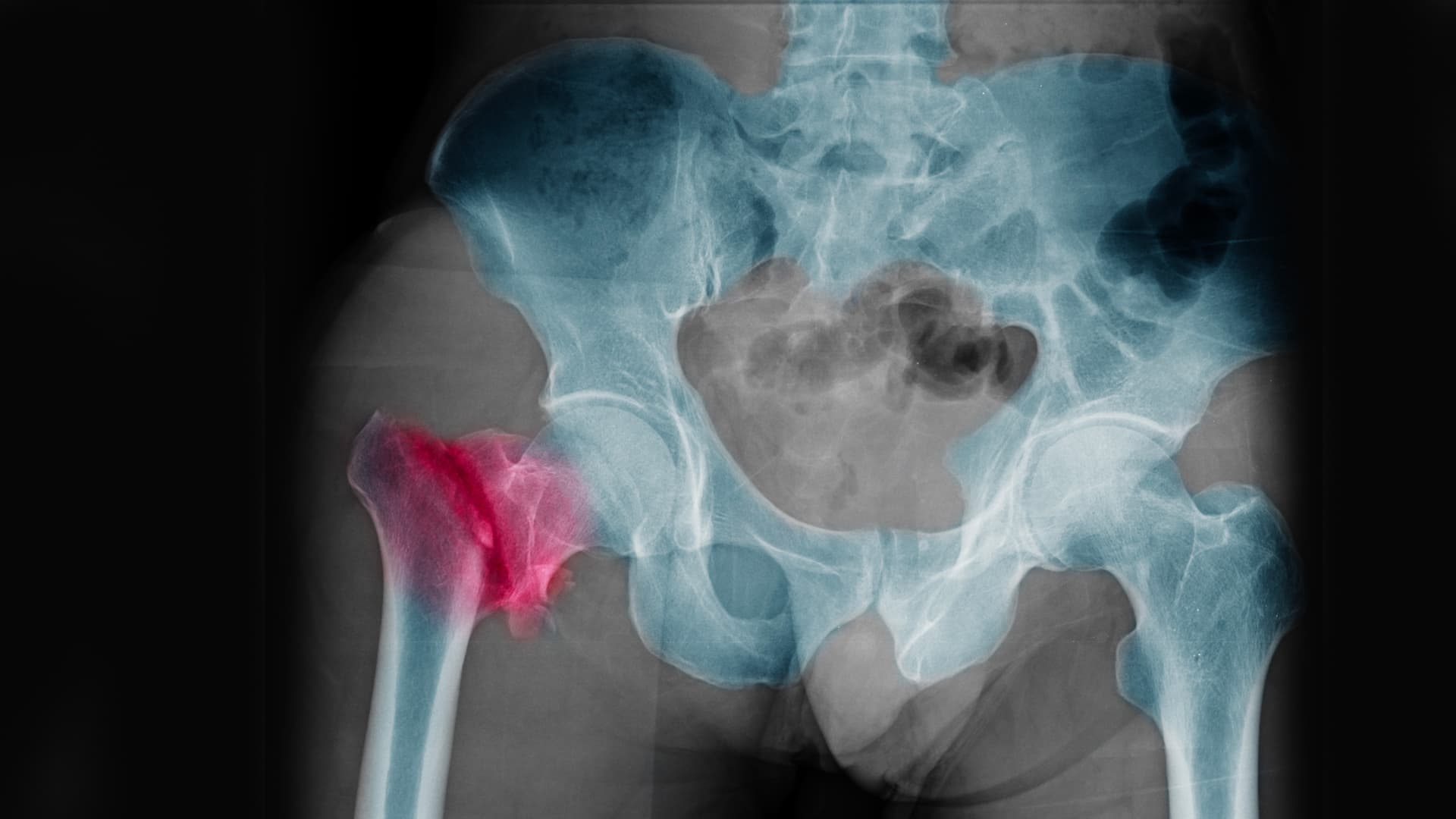 Fracture de hanche | Types de fractures et traitements | CPHG Paris