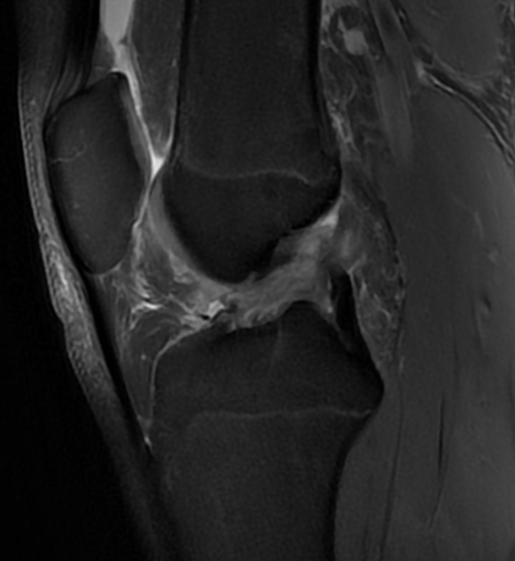 IRM du genou présentant un soucis au niveau du ligament croisé antérieur