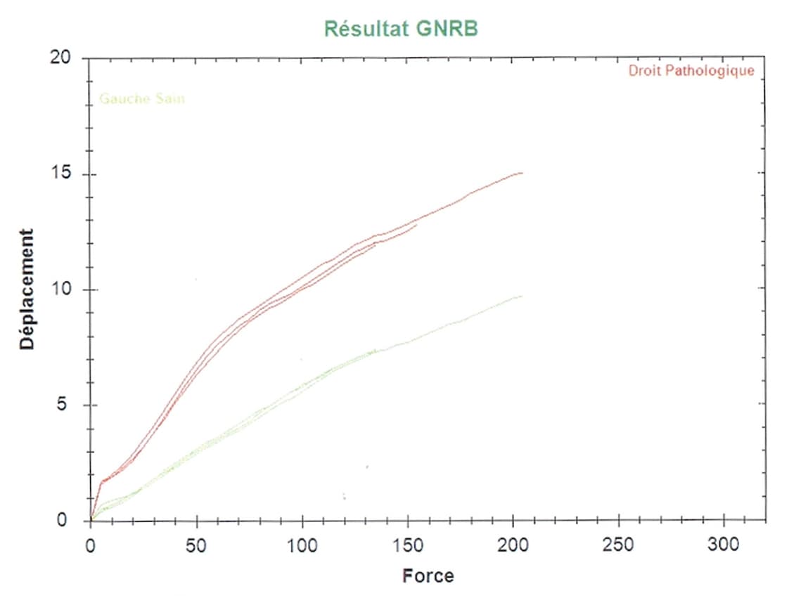 Test de laximétrie de type GNRB présentant une laxité du genou droit