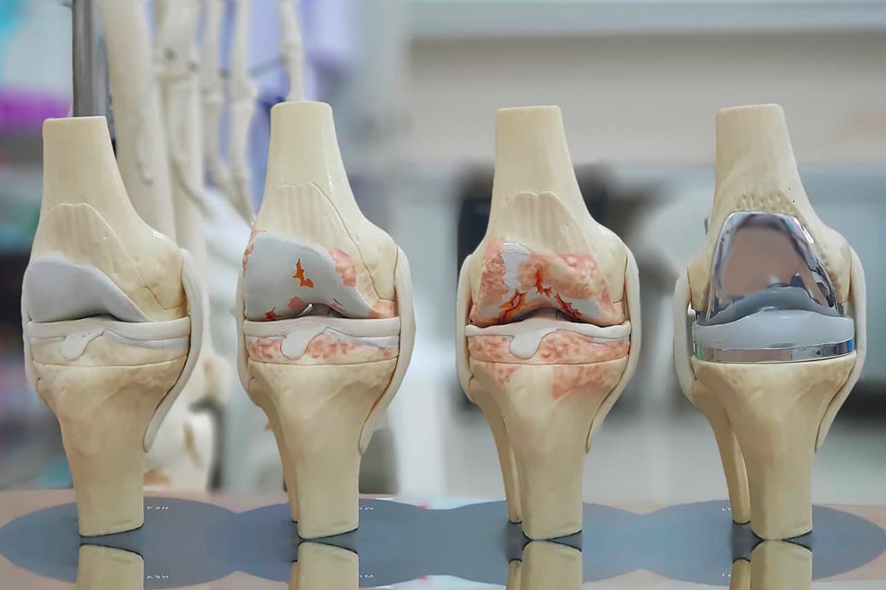 Visualisation de l'évolution de l'arthrose du genou jusqu'à la pose de prothèse