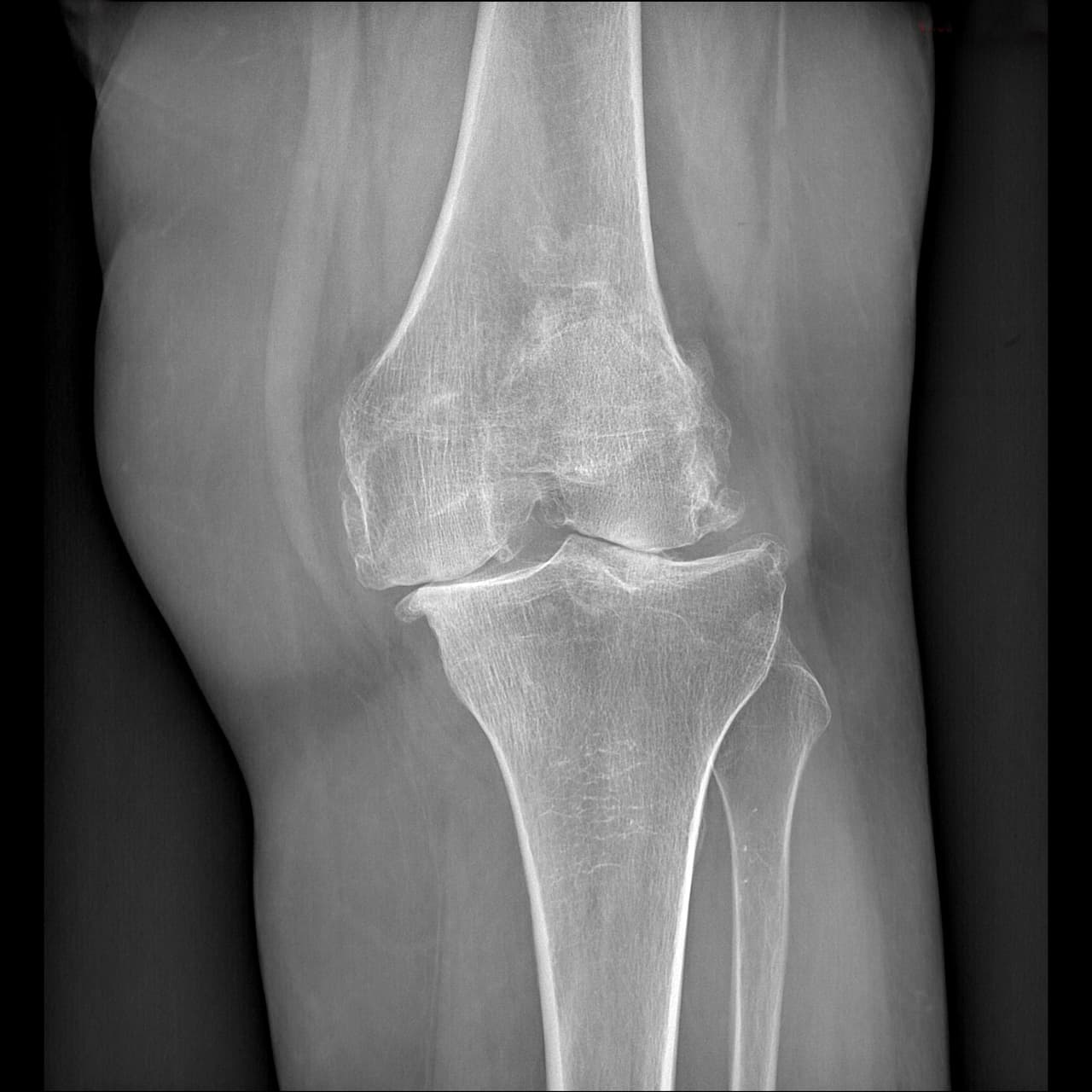 Radio du genou présentant une gonarthrose tricompartimentale évoluée de grade IV.