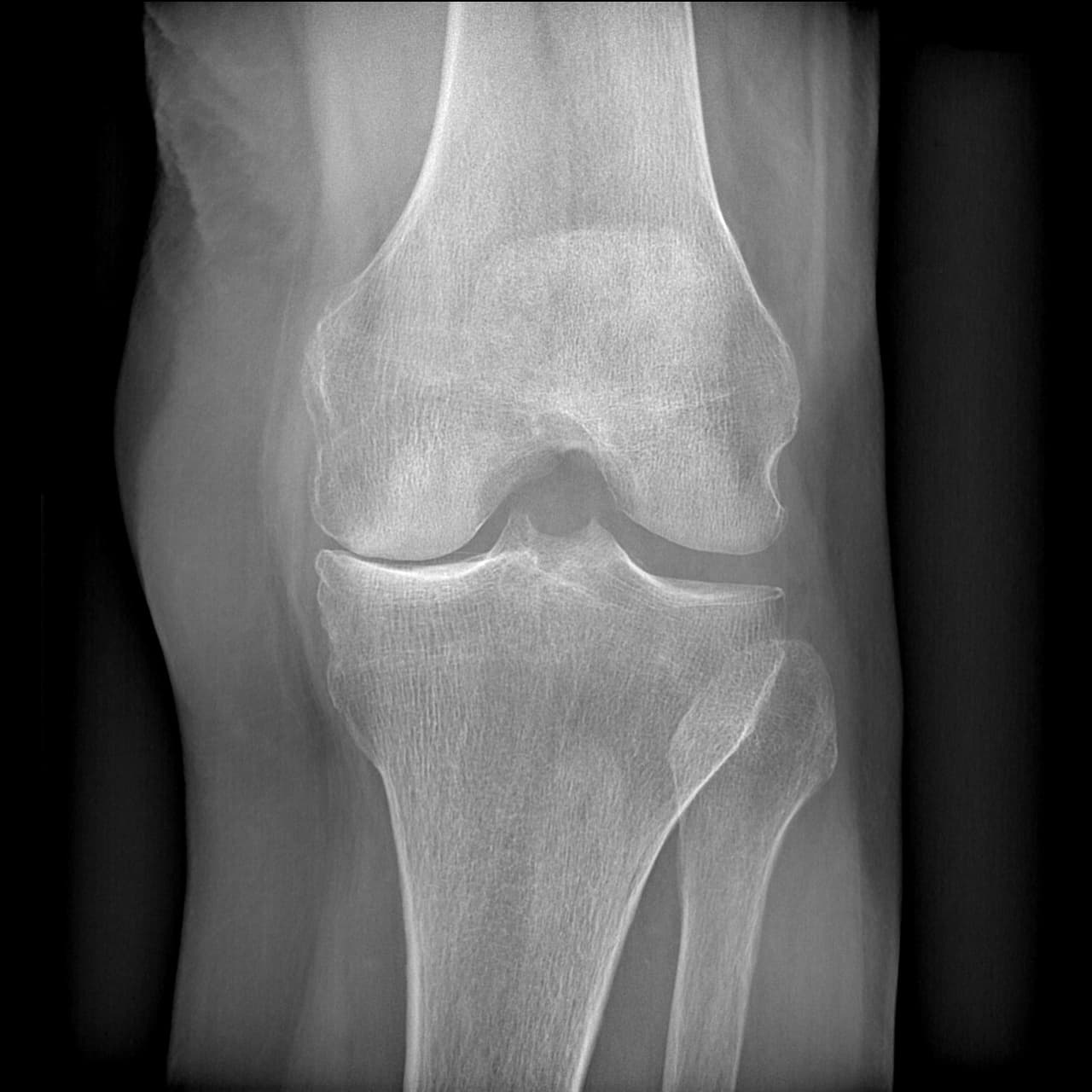Radio du genou présentant une gonarthrose évoluée isolée du compartiment fémorotibial médial gauche.