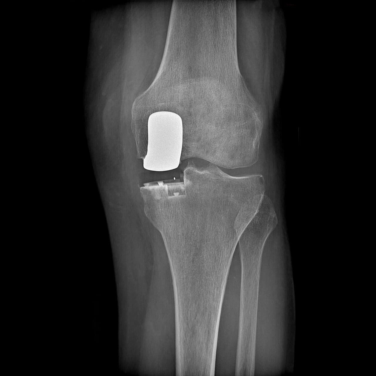 Radiographie post opératoire: pose d'une prothèse unicompartimentale médiale gauche permettant de ne remplacer que le compartiment usé et symptomatique. La partie tibiale est ici composée d'une embase en polyéthylène radiotransparente.