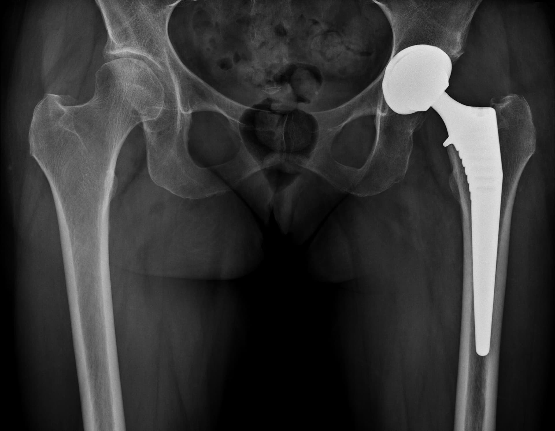 Radiographie post opératoire : pose d'une prothèse totale de hanche par voie antérieure mini invasive de type Bikin (prothèse non cimentée avec couple de frottement céramique/céramique).