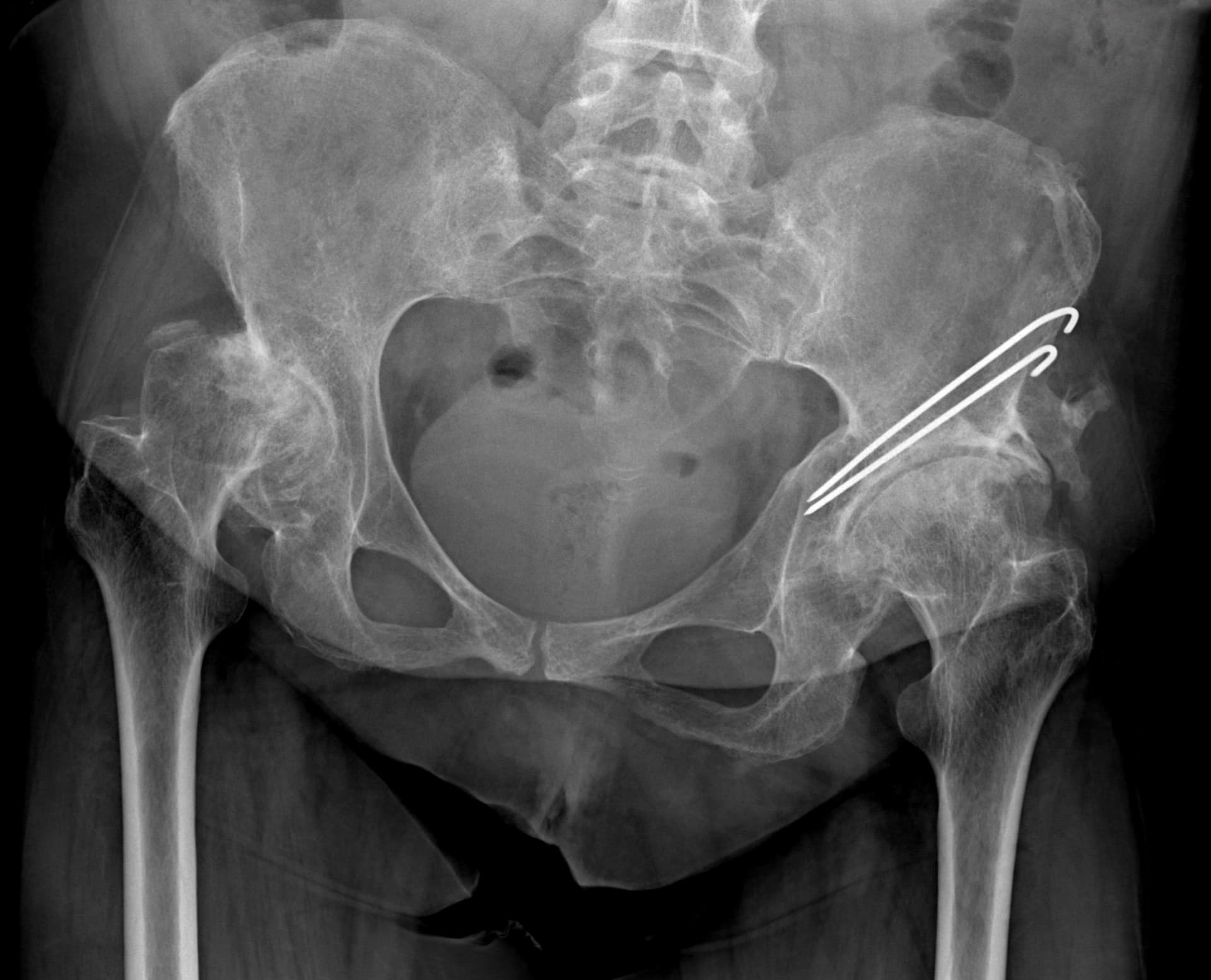 Radio de la hanche présentant une luxation congénitale de hanche droite (dite « appuyée haute ») et séquelle de chirurgie dans l'enfance à la hanche gauche.
