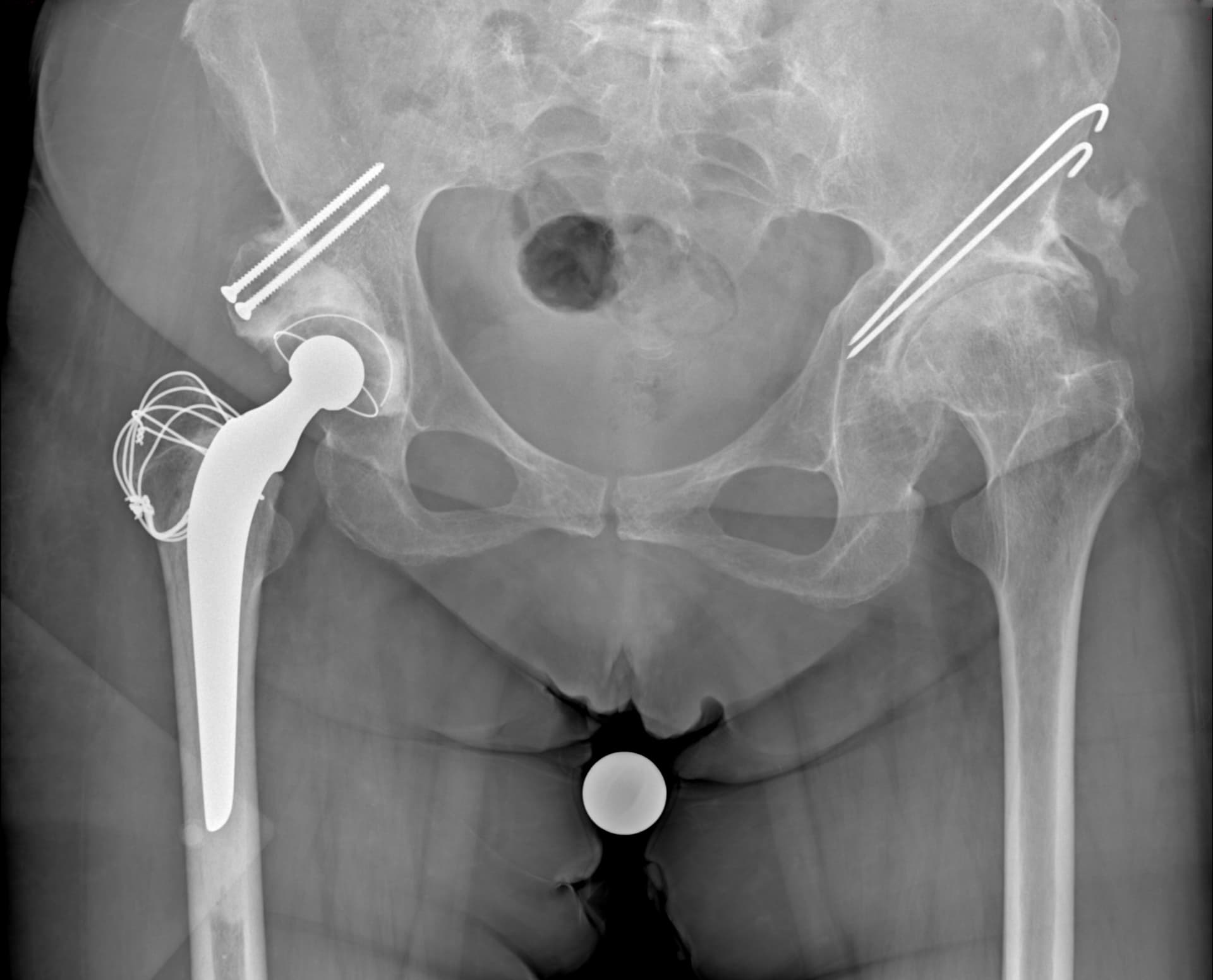 Radiographie post opératoire: pose d'une prothèse totale de hanche droite cimentée par voie transtrochantérienne (trochantérotomie) selon la technique de Cochin avec confection d'une butée osseuse.