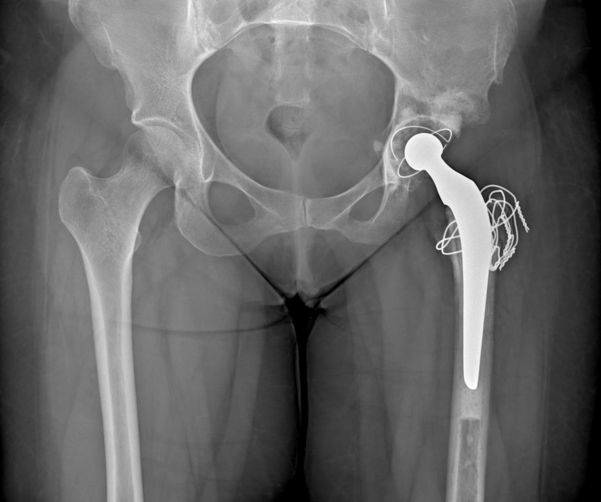 Radiographie post opératoire: pose d'une prothèse totale de hanche gauche par voie transtrochantérienne (trochantérotomie) selon la technique de Cochin permettant la récupération de la longueur du membre (isolongs).