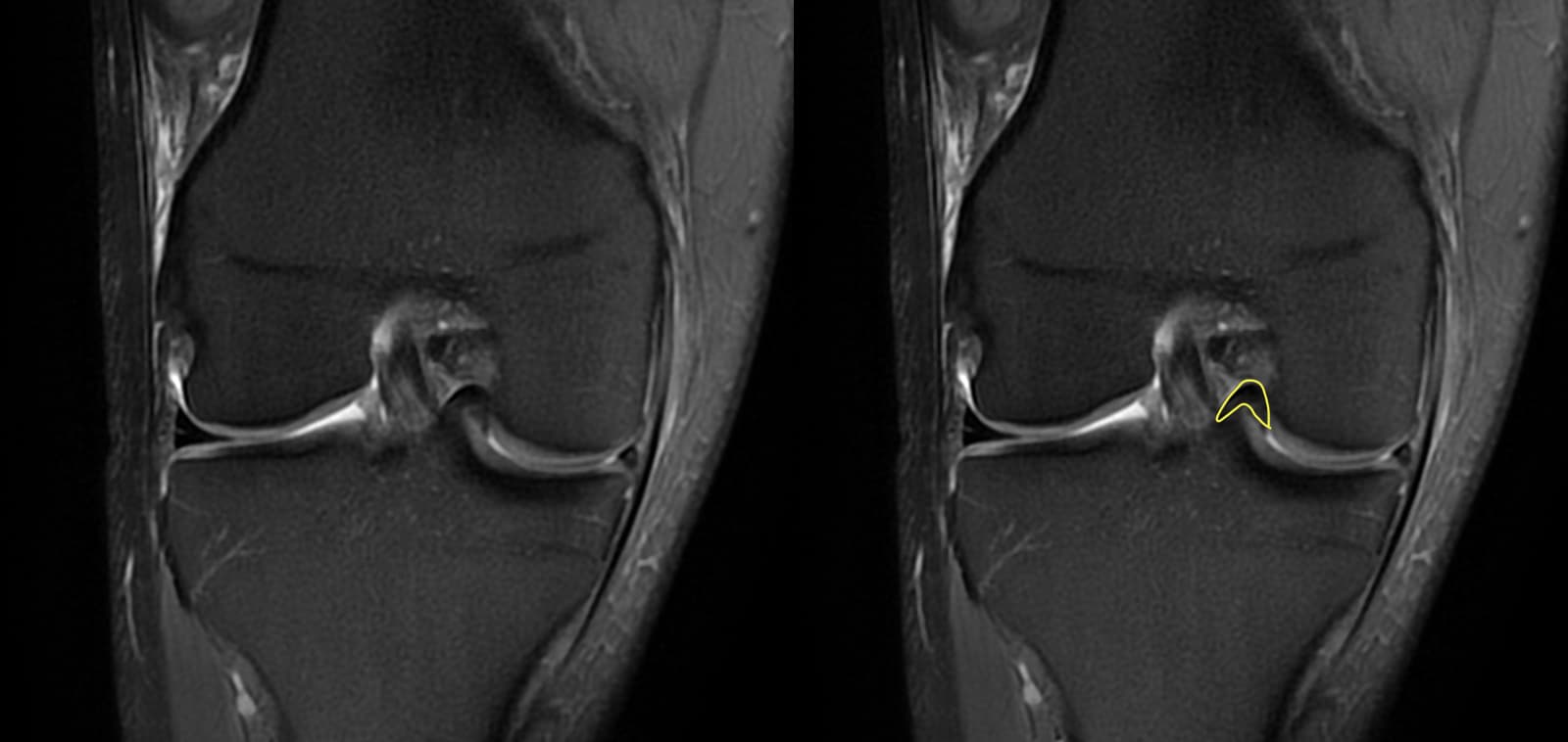 Exemple d'IRM du genou pour une suspicion d'une anse de seau du ménisque